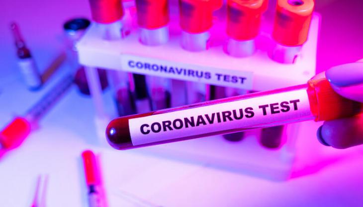 exame-coronavirus-covid19-teste-0320-140-165e